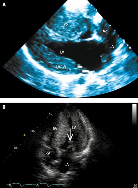 lv septal hypertrophy|interventricular septum hypertrophy.